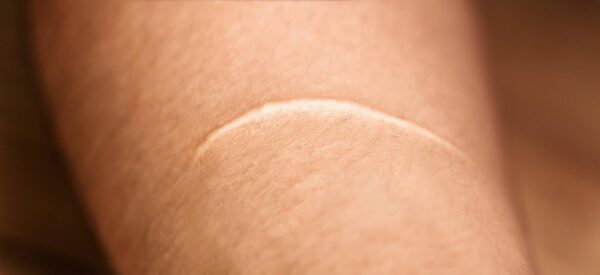 keloids 1600x732 1 600x275 (1)