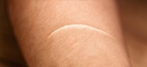 keloids 1600x732 1 600x275