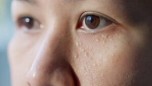 CLEAR Spot Removal: The Quick Fix for Stubborn Skin Imperfections syringoma,milia,milium,cysts,or,seborrheic,keratosis,on,asia,people